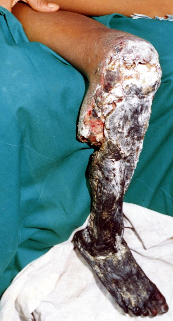 Necrosis of lower limb following Bothrops asper envenoming - Extensive Tissue Necrosis of the Lower Limb in an 11-Year-Old Boy Who Had Been Bitten Two Weeks Earlier by a Bothrops asper in Ecuador

Only antibiotic treatment had been given, so tissue damage was extensive, requiring above-knee amputation. Such pathological alterations are caused by the direct action of locally acting toxins in the venom (mostly metalloproteinases and phospholipases A2), together with an indirect effect promoted by local inflammatory events and ischemia secondary to venom-induced vascular damage and increased intracompartmental pressure. (Image: D. A. Warrell) 
Source: Gutièrrez et al. 2006 https://journals.plos.org/plosmedicine/article?id=10.1371/journal.pmed.0030150