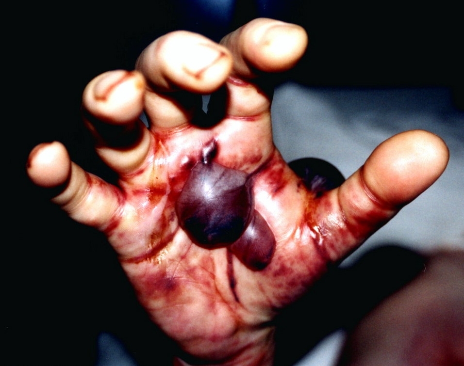 Bothrops taeniatus envenoming - Edema, extensive blistering and spontaneous bleeding of the bitten hand due to Bothrops taeniatus envenoming. Photo by Ulrich Kuch.